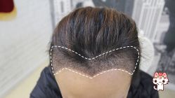 -大麦微针植发丨全国连锁