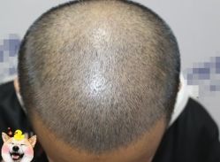 -大麦微针植发丨全国连锁