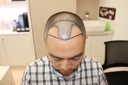 点击看大图 -大麦微针植发丨全国连锁