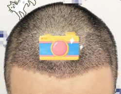 -大麦微针植发全国连锁