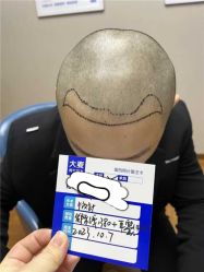 -大麦微针植发全国连锁