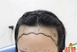 -大麦微针植发全国连锁
