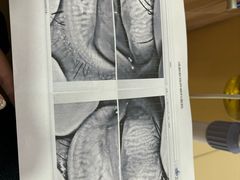 -成都新视界眼科医院·近视手术·儿童近视
