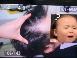 -大麦微针植发全国连锁