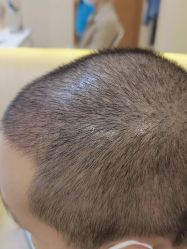 点击看大图 体验后-碧莲盛·不剃发植发