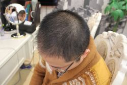 点击看大图 -大麦微针植发丨全国连锁