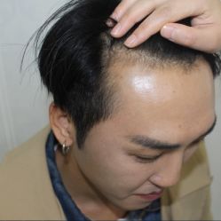 -大麦微针植发丨全国连锁