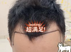 -大麦微针植发全国连锁