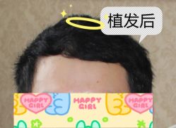 -大麦微针植发全国连锁