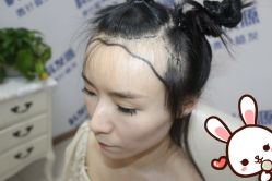 -大麦微针植发丨全国连锁