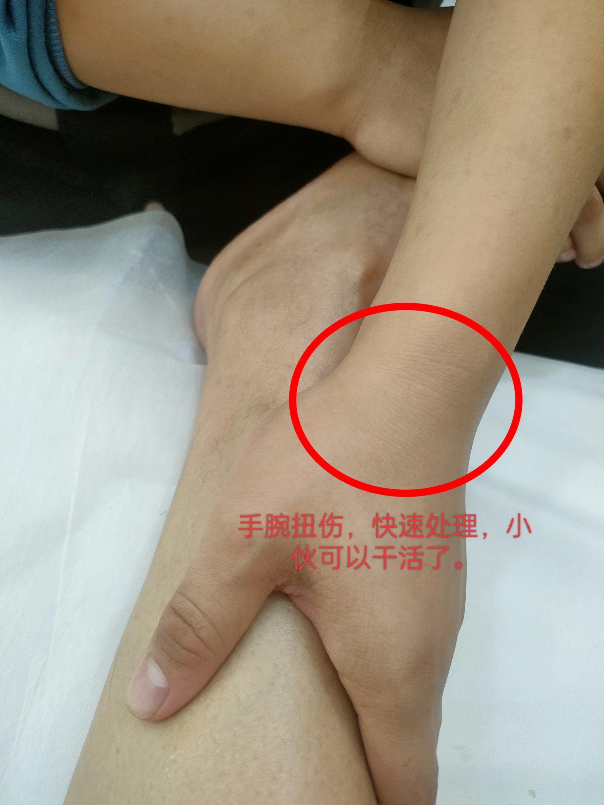 手腕因穿鞋撑地扭伤,骨错位手法处理恢复正常.