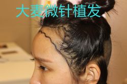 -大麦微针植发丨全国连锁