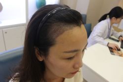 -大麦微针植发丨全国连锁