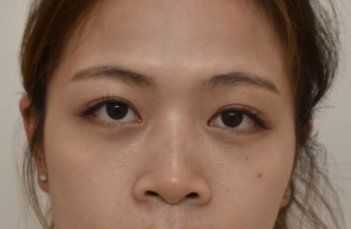 -天津健丽·去眼袋医疗美容机构
