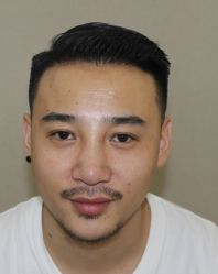 -大麦微针植发全国连锁