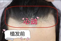 -大麦微针植发全国连锁