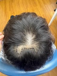 -大麦微针植发全国连锁