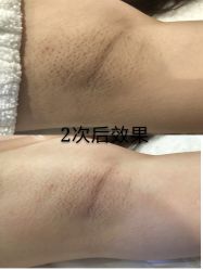 -觅屿日式脱毛美肤