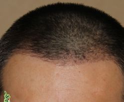 -大麦微针植发丨全国连锁