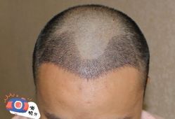 -大麦微针植发丨全国连锁