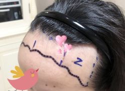 -大麦微针植发全国连锁