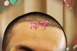 -大麦微针植发全国连锁