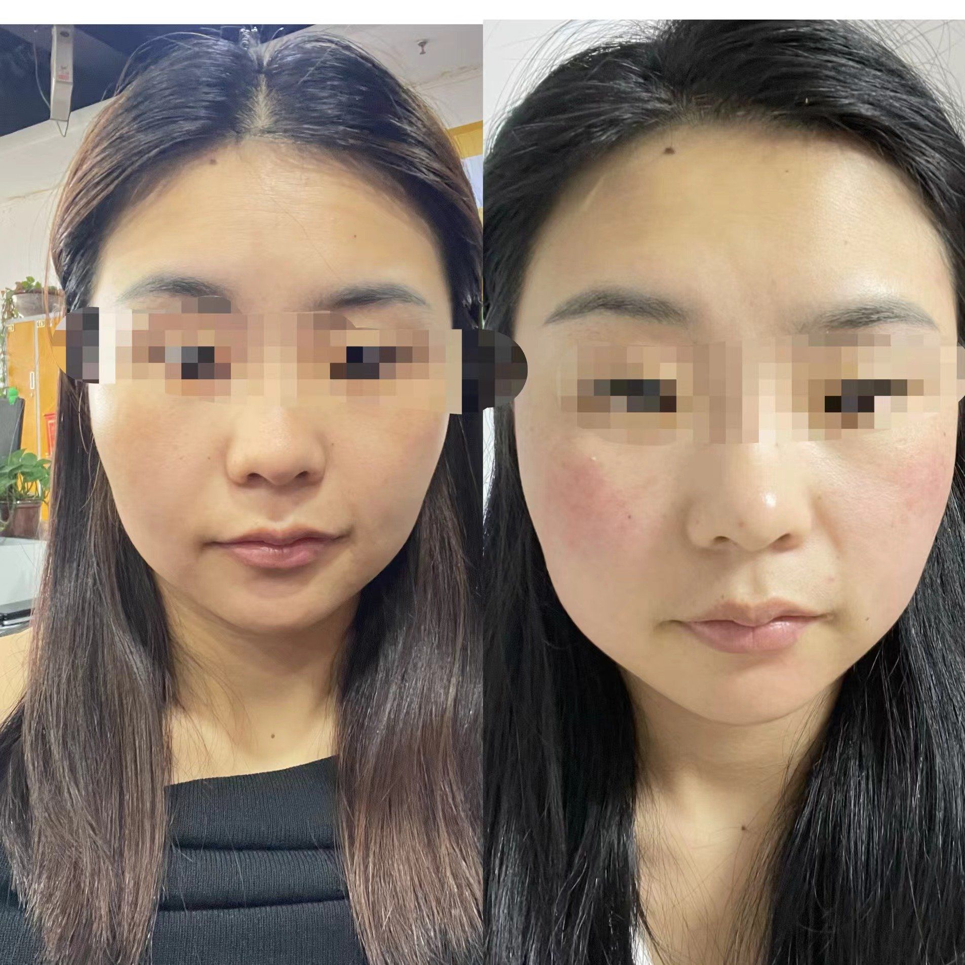 仁和祛红血丝的前后对比效果#红血丝#兰州仁和整形