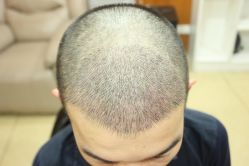 点击看大图 -大麦微针植发丨全国连锁