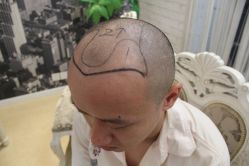 点击看大图 -大麦微针植发丨全国连锁