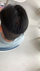 体验后-大麦微针植发全国连锁
