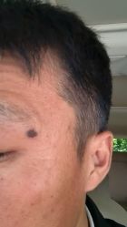 -北京美痣堂古方祛痣斑疣瘊