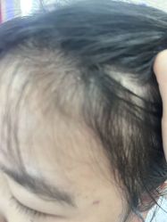 -大麦微针植发丨全国连锁