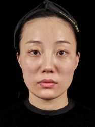 体验前-南宁华美医疗美容医院