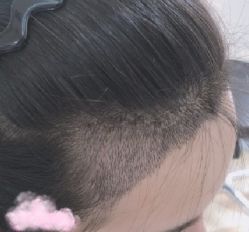 -大麦微针植发丨全国连锁