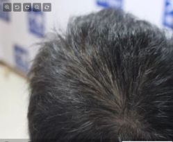 -大麦微针植发丨全国连锁