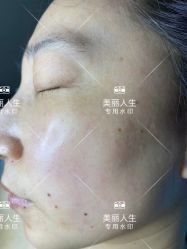 -美丽人生祛斑扁平疣汗管瘤中心