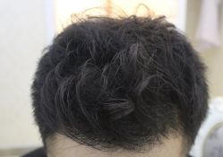 -大麦微针植发丨全国连锁