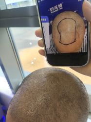 -碧莲盛·不剃发植发