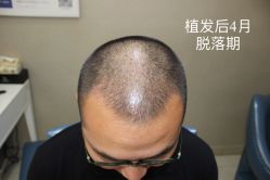 点击看大图 -大麦微针植发全国连锁