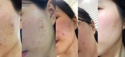 点击看大图 -瓷肌博士·祛痘科技美肤