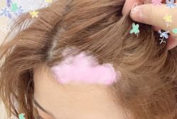 -大麦微针植发全国连锁