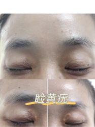 -爱莎扁平疣·汗管瘤·斑痣中心