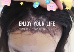 -大麦微针植发全国连锁