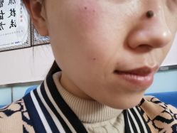 -北京美痣堂古方祛痣斑疣瘊