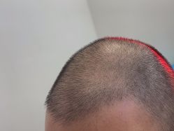 -大麦微针植发全国连锁