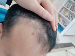 -碧莲盛·不剃发植发