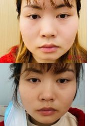 体验后-成都艾特他整形外科医院
