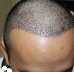 -大麦微针植发丨全国连锁