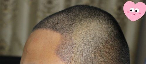 -大麦微针植发丨全国连锁