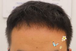 -大麦微针植发全国连锁